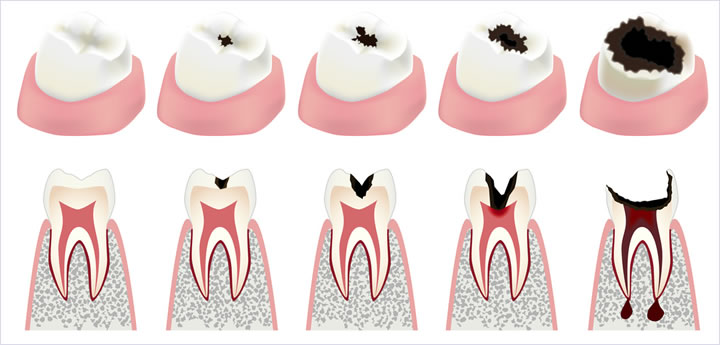 虫歯の進行と治療法