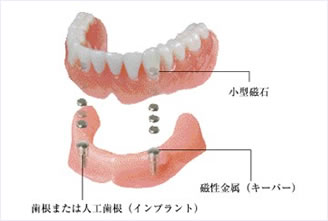 磁性アタッチメント義歯