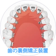 裏側矯正装置（舌側矯正）