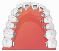 裏側矯正（舌側矯正）