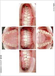 口腔写真