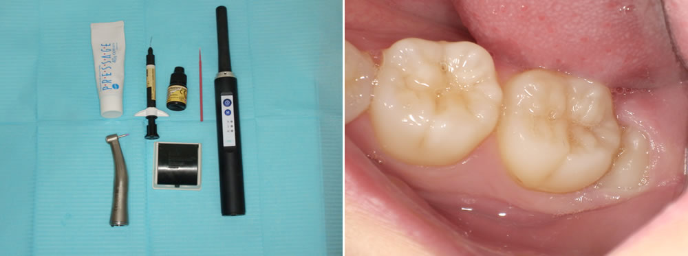 シーラントによる虫歯予防の症例