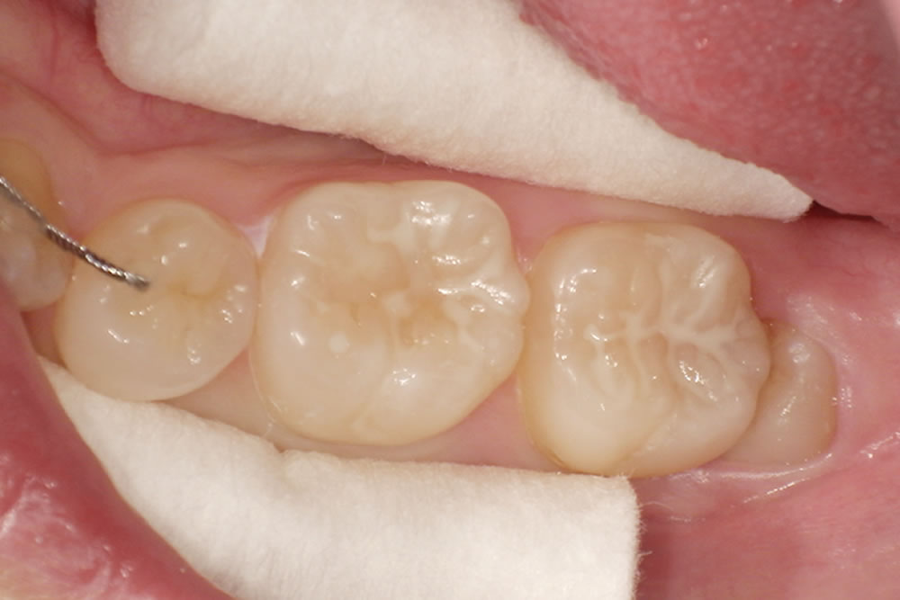 シーラント材の塗布