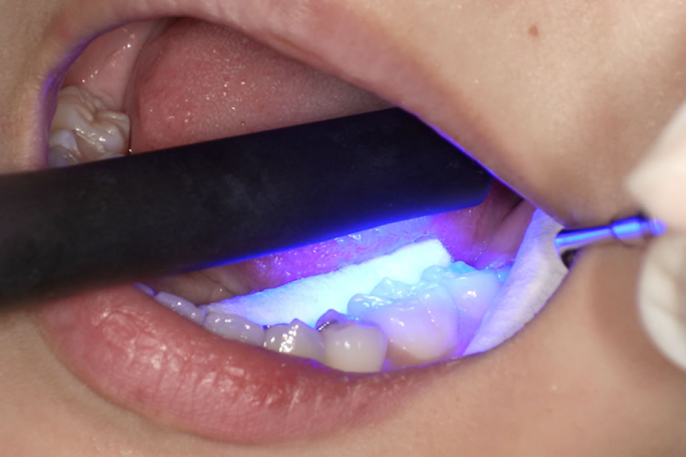 光を照射して硬化