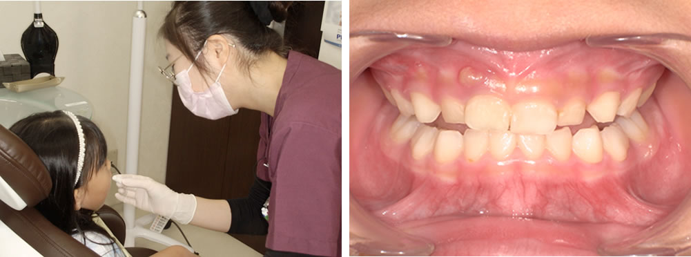 ワセリンの塗布