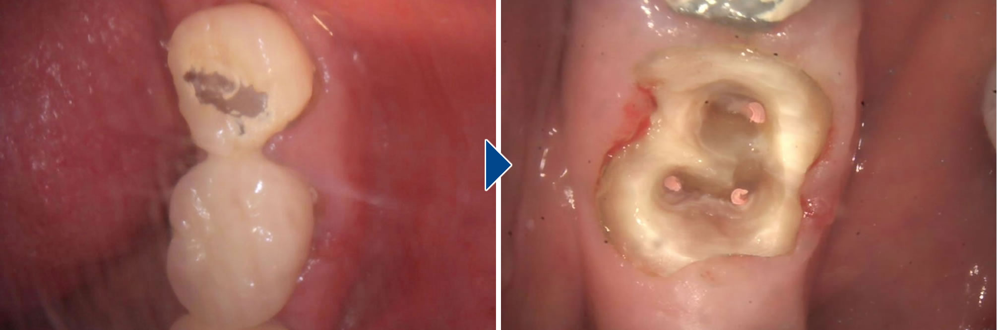 根管治療の実施
