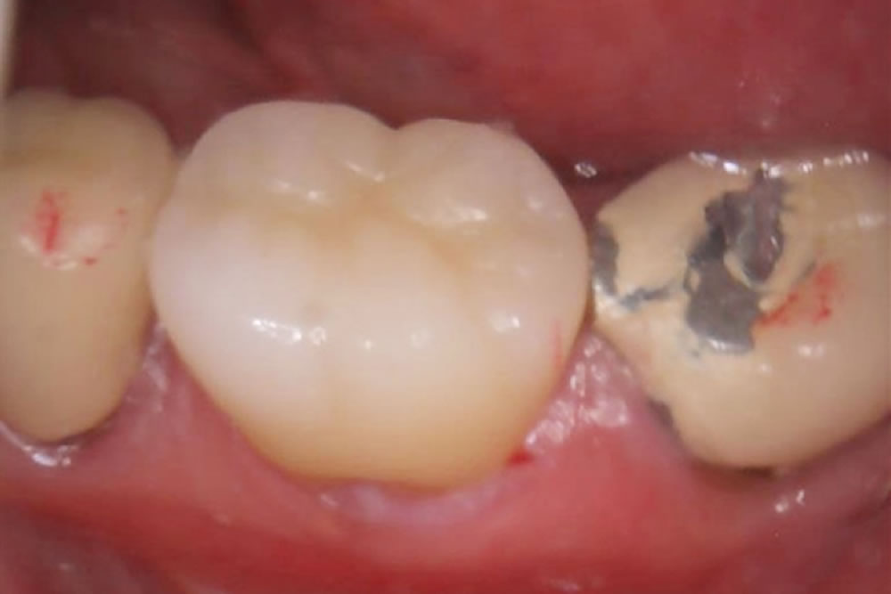 ジルコニアクラウン装着・治療完了