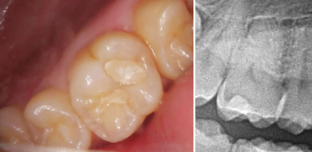 初診時の口腔内