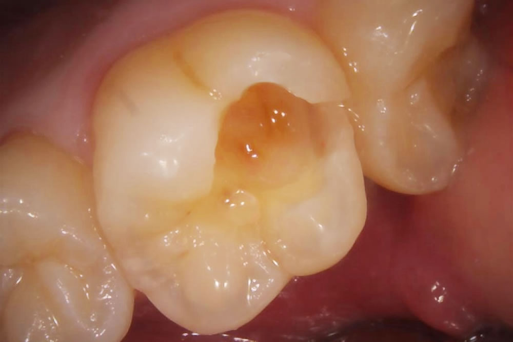 初診時の口腔内