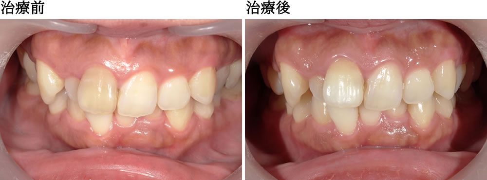 ウォーキングブリーチ前後の比較